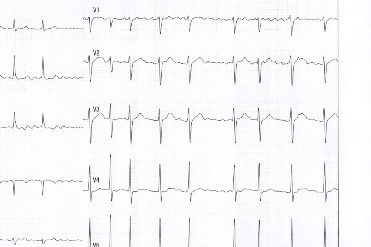 脈が乱れた心電図
